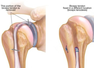 Biceps Tendinitis 7Scope Ortho Care