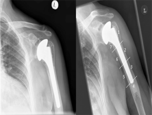 Shoulder Hemiarthroplasty - 7Scope Ortho Care