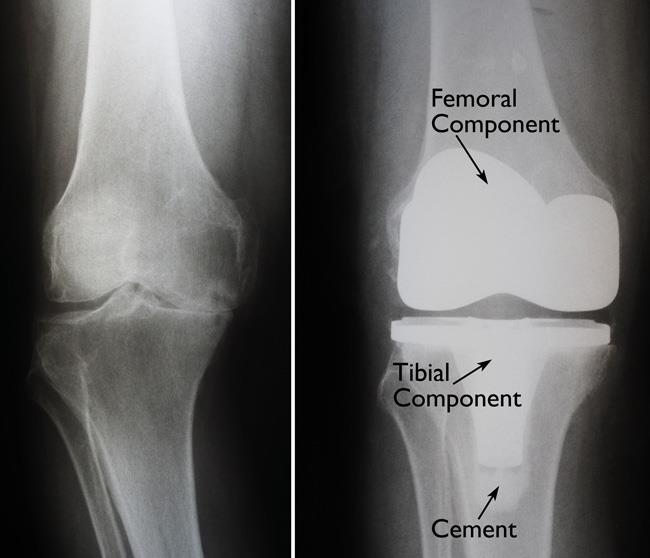 Robotic Knee Replacement